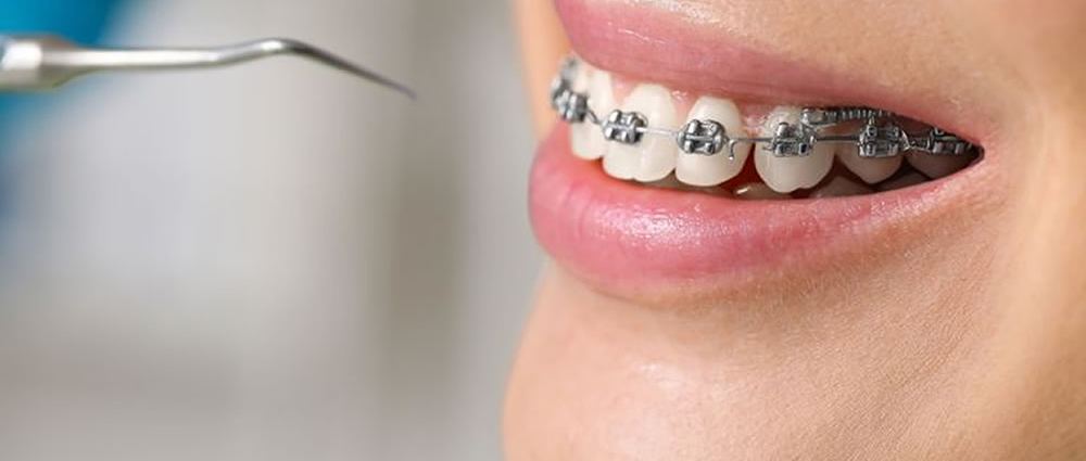 Tratamiento de ortodoncia con brackets