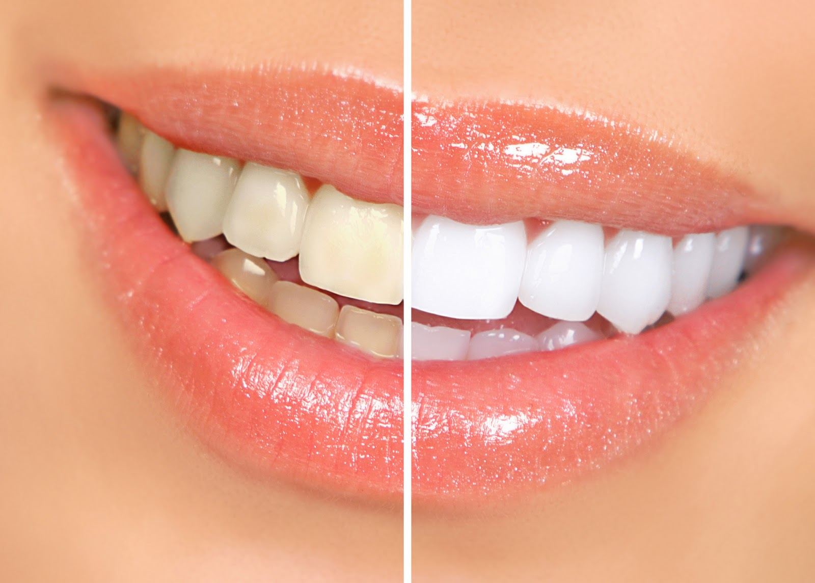 Antes y después de un blanqueamiento dental