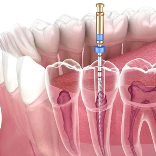 Endodoncia