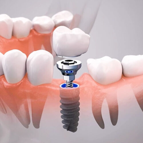 Implantes dentales
